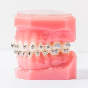 festsitzende Zahnspange, Brackets